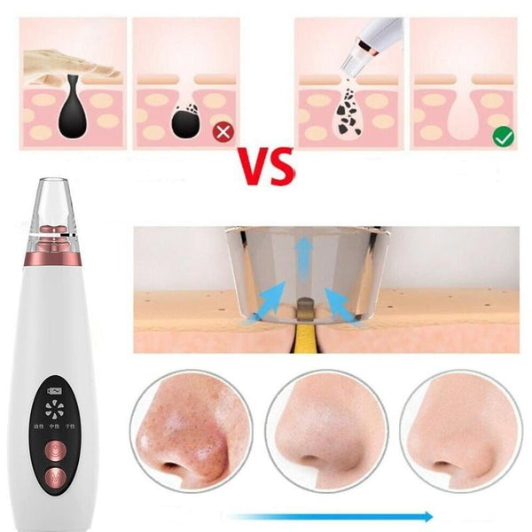 Pore and blackhead remover